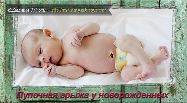 Как выглядит пупочная грыжа у новорожденных