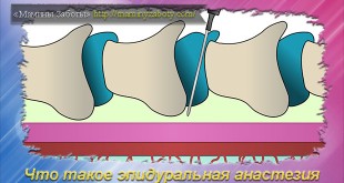 эпидуральная анастезия за и против
