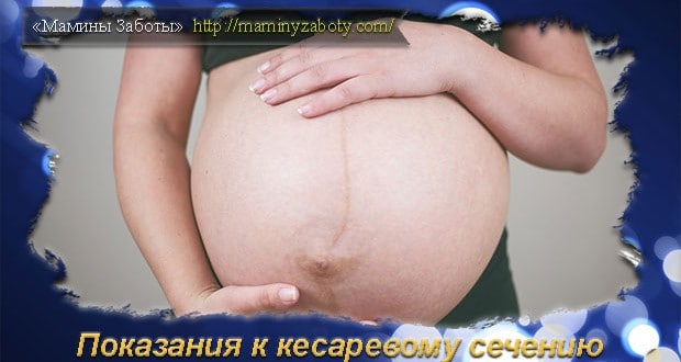 почему делают кесарево