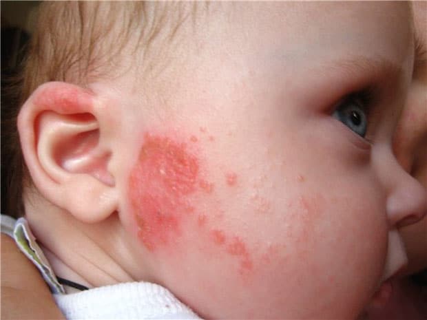 Атопический дерматит у детей по комаровскому thumbnail