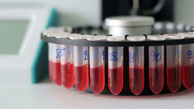 расшифровка глюкозотолерантного теста