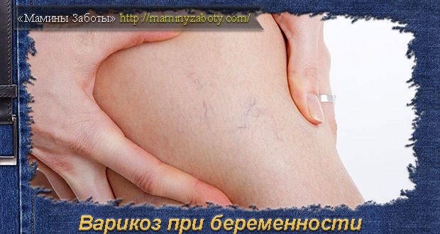 варикоз на ногах при беременности